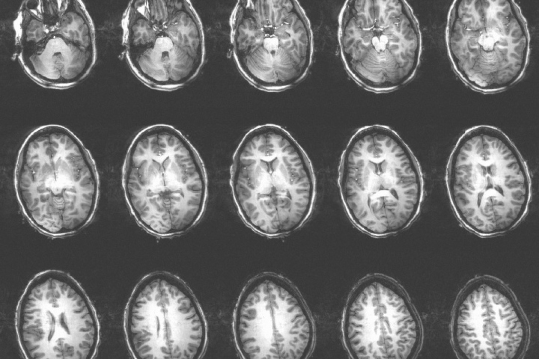 Речь как зеркало мышления: приглашение помочь в разработке диагностики и лечения патологий мозга